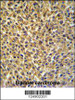 CRIP1 Antibody IHC analysis in formalin fixed and paraffin embedded bladder carcinoma followed by peroxidase conjugation of the secondary antibody and DAB staining.
