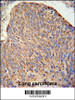 CC130 Antibody IHC analysis in formalin fixed and paraffin embedded human lung carcinoma followed by peroxidase conjugation of the secondary antibody and DAB staining.