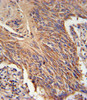 RDH10 Antibody immunohistochemistry analysis in formalin fixed and paraffin embedded lung carcinoma followed by peroxidase conjugation of the secondary antibody and DAB staining.