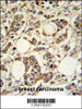 PIGM Antibody IHC analysis in formalin fixed and paraffin embedded breast carcinoma followed by peroxidase conjugation of the secondary antibody and DAB staining.