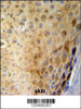 GSDMA Antibody IHC analysis in formalin fixed and paraffin embedded human skin carcinoma followed by peroxidase conjugation of the secondary antibody and DAB staining.