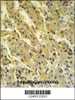 PSG7 Antibody IHC analysis in formalin fixed and paraffin embedded hepatocarcinoma followed by peroxidase conjugation of the secondary antibody and DAB staining.