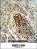 MFAP4 Antibody IHC analysis in formalin fixed and paraffin embedded human lung carcinoma followed by peroxidase conjugation of the secondary antibody and DAB staining.