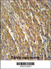 PDXD1 Antibody immunohistochemistry analysis in formalin fixed and paraffin embedded human cervix carcinoma followed by peroxidase conjugation of the secondary antibody and DAB staining.