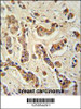 FA20A Antibody immunohistochemistry analysis in formalin fixed and paraffin embedded human breast carcinoma tissue followed by peroxidase conjugation of the secondary antibody and DAB staining.