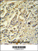ASM3A Antibody IHC analysis in formalin fixed and paraffin embedded breast carcinoma followed by peroxidase conjugation of the secondary antibody and DAB staining.