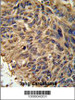 FBXL2 Antibody IHC analysis in formalin fixed and paraffin embedded human lung carcinoma followed by peroxidase conjugation of the secondary antibody and DAB staining.