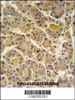 IN80D Antibody IHC analysis in formalin fixed and paraffin embedded human hepatocarcinoma followed by peroxidase conjugation of the secondary antibody and DAB staining.