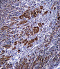 S100B Antibody immunohistochemistry analysis in formalin fixed and paraffin embedded human malignant melanoma followed by peroxidase conjugation of the secondary antibody and DAB staining.