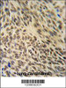 XRCC6 Antibody IHC analysis in formalin fixed and paraffin embedded human lung carcinoma followed by peroxidase conjugation of the secondary antibody and DAB staining.
