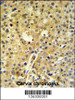 C2orf49 Antibody IHC analysis in formalin fixed and paraffin embedded human cervix carcinoma followed by peroxidase conjugation of the secondary antibody and DAB staining.