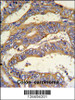 RSAD1 Antibody IHC analysis in formalin fixed and paraffin embedded human colon carcinoma followed by peroxidase conjugation of the secondary antibody and DAB staining.