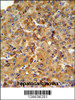 SFT2D3 Antibody IHC analysis in formalin fixed and paraffin embedded human hepatocarcinoma followed by peroxidase conjugation of the secondary antibody and DAB staining.