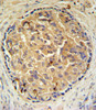 SRD5A3 Antibody IHC analysis in formalin fixed and paraffin embedded human prostate carcinoma followed by peroxidase conjugation of the secondary antibody and DAB staining.