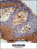 DHRS2 Antibody immunohistochemistry analysis in formalin fixed and paraffin embedded human skin carcinoma followed by peroxidase conjugation of the secondary antibody and DAB staining.