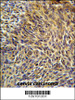 ANKRD32 Antibody immunohistochemistry analysis in formalin fixed and paraffin embedded human cervix carcinoma followed by peroxidase conjugation of the secondary antibody and DAB staining.