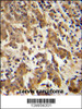 GKAP1 Antibody immunohistochemistry analysis in formalin fixed and paraffin embedded human cervix carcinoma followed by peroxidase conjugation of the secondary antibody and DAB staining.