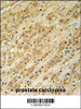 DKC1 Antibody immunohistochemistry analysis in formalin fixed and paraffin embedded human prostate carcinoma followed by peroxidase conjugation of the secondary antibody and DAB staining.