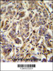 FLJ11506 Antibody immunohistochemistry analysis in formalin fixed and paraffin embedded human cervix carcinoma followed by peroxidase conjugation of the secondary antibody and DAB staining.
