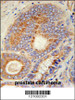 HHAT Antibody immunohistochemistry analysis in formalin fixed and paraffin embedded human prostate carcinoma followed by peroxidase conjugation of the secondary antibody and DAB staining.