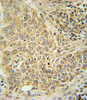 AHR Antibody immunohistochemistry analysis in formalin fixed and paraffin embedded human lung carcinoma followed by peroxidase conjugation of the secondary antibody and DAB staining.