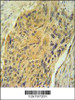 AVP Antibody immunohistochemistry analysis in formalin fixed and paraffin embedded human lung carcinoma followed by peroxidase conjugation of the secondary antibody and DAB staining.