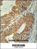 TSPAN3 Antibody immunohistochemistry analysis in formalin fixed and paraffin embedded human colon carcinoma followed by peroxidase conjugation of the secondary antibody and DAB staining.