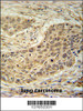 TAF1D Antibody immunohistochemistry analysis in formalin fixed and paraffin embedded human lung carcinoma followed by peroxidase conjugation of the secondary antibody and DAB staining.