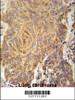 PCYXL Antibody immunohistochemistry analysis in formalin fixed and paraffin embedded human Lung carcinoma followed by peroxidase conjugation of the secondary antibody and DAB staining.