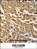 ZNF313 Antibody immunohistochemistry analysis in formalin fixed and paraffin embedded human skin carcinoma followed by peroxidase conjugation of the secondary antibody and DAB staining.