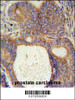 LYSMD1 Antibody immunohistochemistry analysis in formalin fixed and paraffin embedded human prostate carcinoma followed by peroxidase conjugation of the secondary antibody and DAB staining.