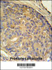 LOH12CR1 Antibody immunohistochemistry analysis in formalin fixed and paraffin embedded human prostate carcinoma followed by peroxidase conjugation of the secondary antibody and DAB staining.