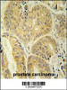 ENAM antibody immunohistochemistry analysis in formalin fixed and paraffin embedded human prostate carcinoma followed by peroxidase conjugation of the secondary antibody and DAB staining.
