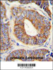 DNAJA1 Antibody immunohistochemistry analysis in formalin fixed and paraffin embedded human prostate carcinoma followed by peroxidase conjugation of the secondary antibody and DAB staining.