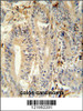 MEP1A antibody immunohistochemistry analysis in formalin fixed and paraffin embedded human colon carcinoma followed by peroxidase conjugation of the secondary antibody and DAB staining.