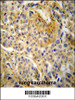 NCF1 Antibody immunohistochemistry analysis in formalin fixed and paraffin embedded human lung carcinoma followed by peroxidase conjugation of the secondary antibody and DAB staining.