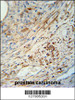 KIF9 antibody immunohistochemistry analysis in formalin fixed and paraffin embedded human prostate carcinoma followed by peroxidase conjugation of the secondary antibody and DAB staining.