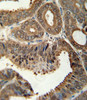 SFN antibody immunohistochemistry analysis in formalin fixed and paraffin embedded human prostate carcinoma followed by peroxidase conjugation of the secondary antibody and DAB staining.