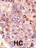 Formalin-fixed and paraffin-embedded human cancer tissue reacted with the primary antibody, which was peroxidase-conjugated to the secondary antibody, followed by DAB staining. BC = breast carcinoma; HC = hepatocarcinoma.