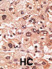 Formalin-fixed and paraffin-embedded human cancer tissue reacted with the primary antibody, which was peroxidase-conjugated to the secondary antibody, followed by AEC staining. BC = breast carcinoma; HC = hepatocarcinoma.