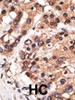 Formalin-fixed and paraffin-embedded human cancer tissue reacted with the primary antibody, which was peroxidase-conjugated to the secondary antibody, followed by AEC staining. BC = breast carcinoma; HC = hepatocarcinoma.