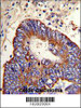 Formalin-fixed and paraffin-embedded human colon carcinoma with MMP15 Antibody (N-term) , which was peroxidase-conjugated to the secondary antibody, followed by DAB staining.