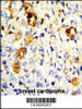 Formalin-fixed and paraffin-embedded human breast carcinoma with MMP19 Antibody, which was peroxidase-conjugated to the secondary antibody, followed by DAB staining.