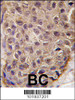 Formalin-fixed and paraffin-embedded human breast carcinoma tissue reacted with OAS1 antibody, which was peroxidase-conjugated to the secondary antibody, followed by DAB staining.