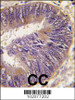 Formalin-fixed and paraffin-embedded human colon carcinoma tissue reacted with ST13 antibody (N-term) , which was peroxidase-conjugated to the secondary antibody, followed by DAB staining.