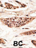 Formalin-fixed and paraffin-embedded human cancer tissue reacted with the primary antibody, which was peroxidase-conjugated to the secondary antibody, followed by AEC staining. BC = breast carcinoma; HC = hepatocarcinoma.