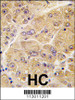 Formalin-fixed and paraffin-embedded human hepatocarcinoma tissue reacted with SOST antibody, which was peroxidase-conjugated to the secondary antibody, followed by DAB staining.