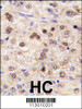 Formalin-fixed and paraffin-embedded human hepatocarcinoma tissue reacted with ZBTB7B antibody, which was peroxidase-conjugated to the secondary antibody, followed by DAB staining.