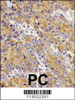 Formalin-fixed and paraffin-embedded human prostata carcinoma tissue reacted with MYO1C antibody, which was peroxidase-conjugated to the secondary antibody, followed by DAB staining.