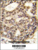 Formalin-fixed and paraffin-embedded human hepatocarcinoma tissue reacted with HDGF antibody, which was peroxidase-conjugated to the secondary antibody, followed by DAB staining.